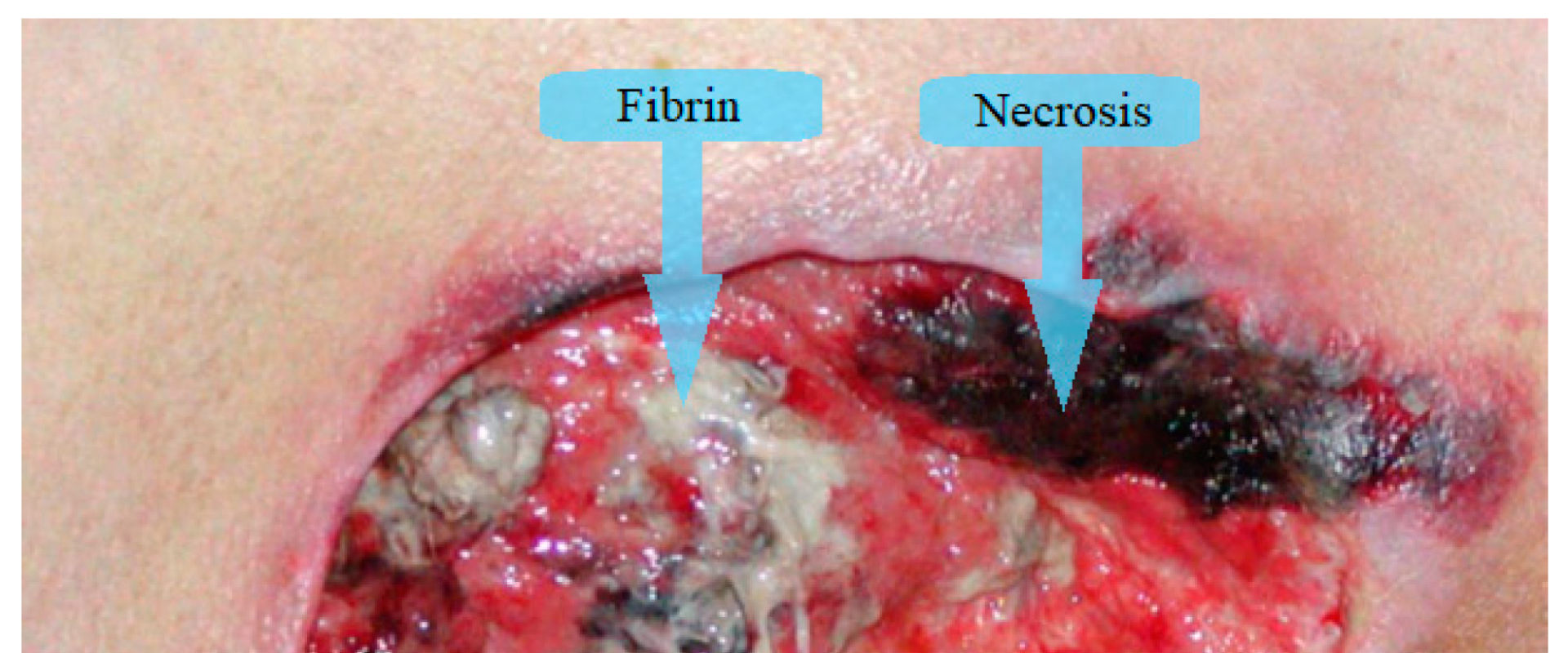 What Is Granulation Tissue? How It Helps Heal Skin Ulcers