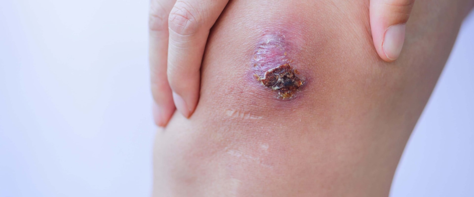 Understanding the Most Common Type of Skin Ulcer