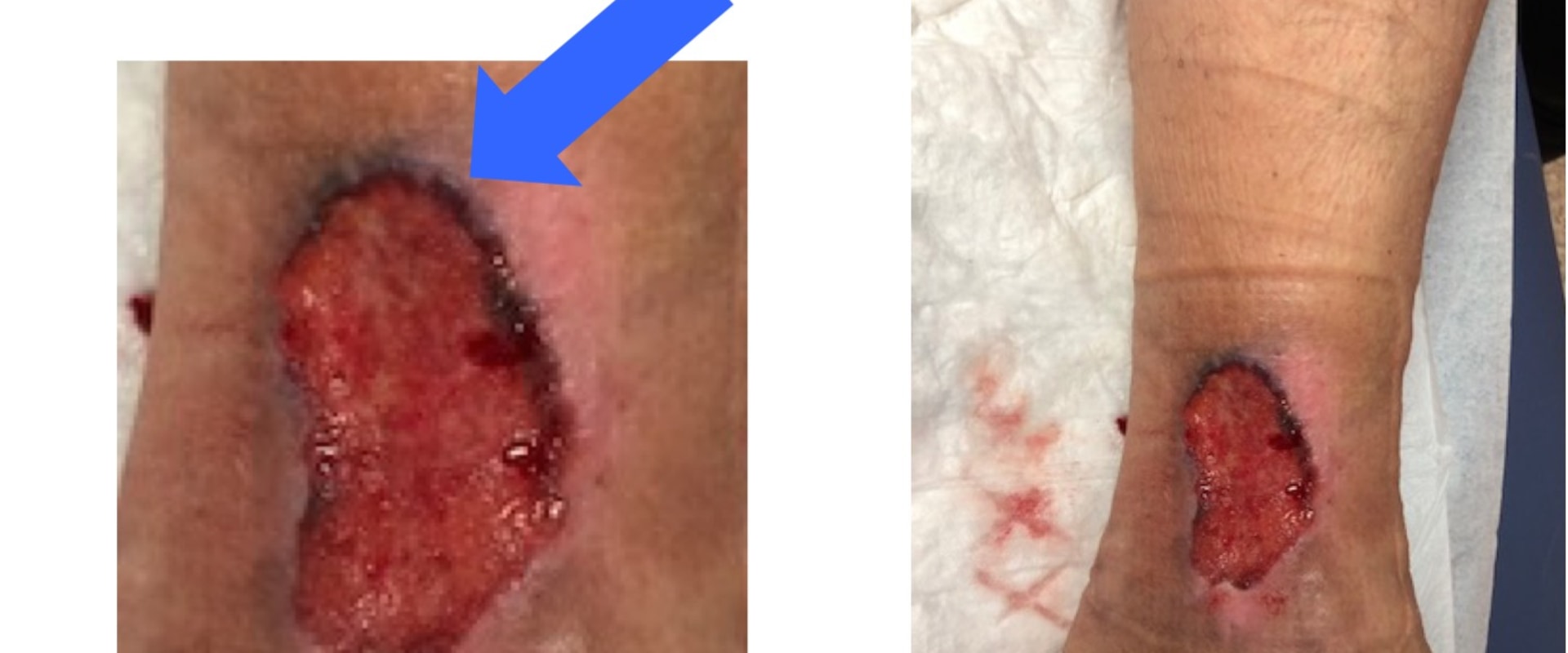 The Importance of Properly Treating and Covering Wounds