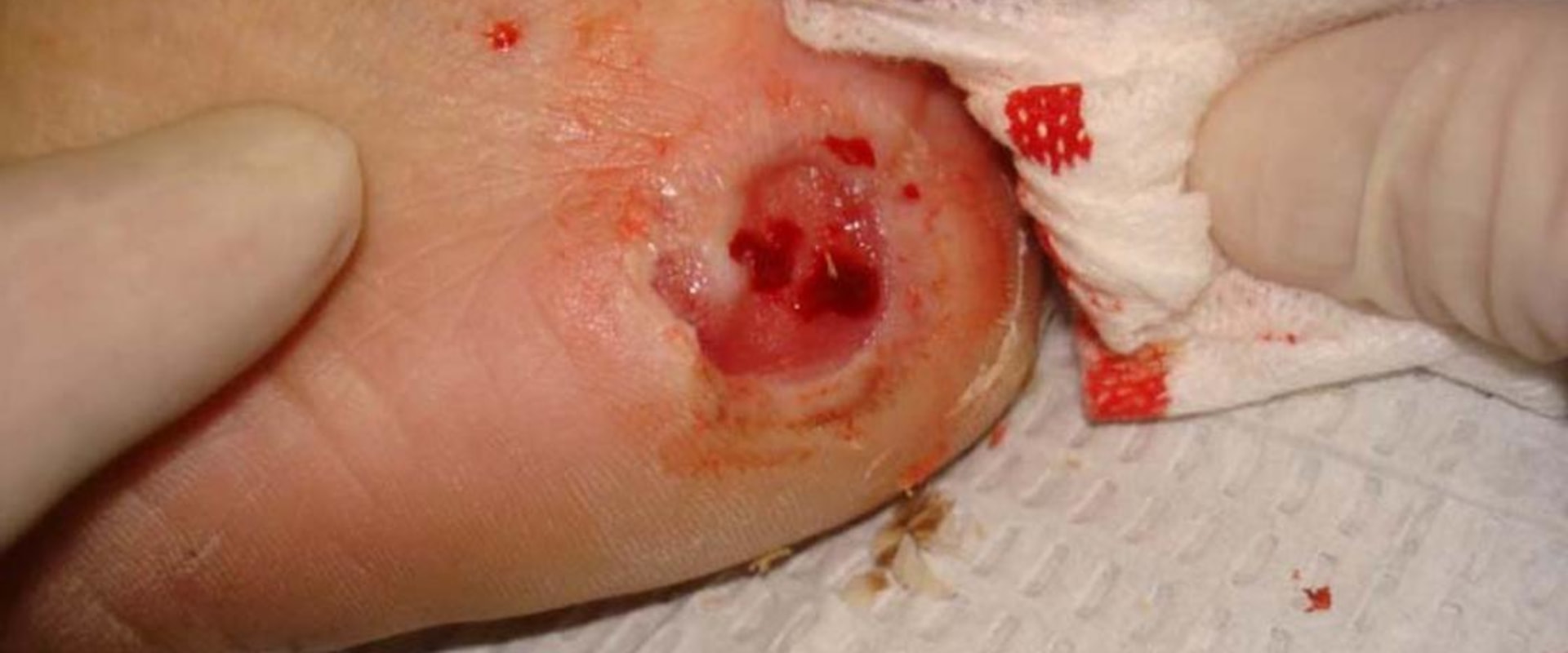 The Consequences of Untreated Skin Ulcers: What You Need to Know