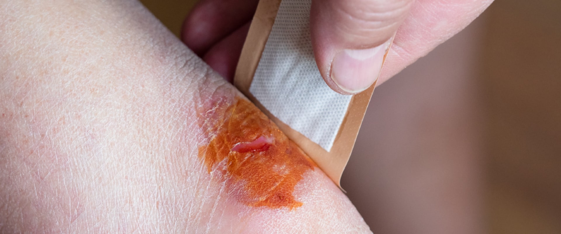 The Best Antibiotic Cream for Wound Healing