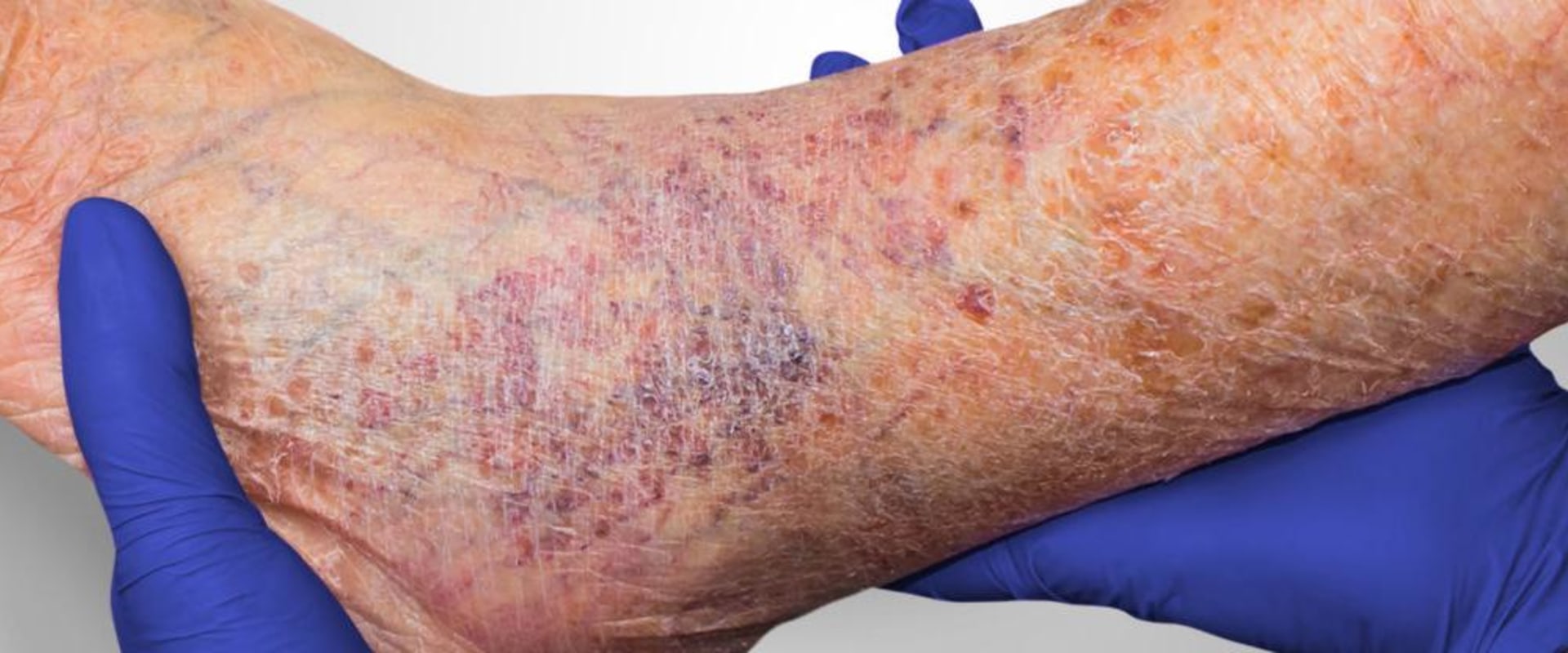 The Power of Moisture: Accelerating Wound Healing for Ulcers