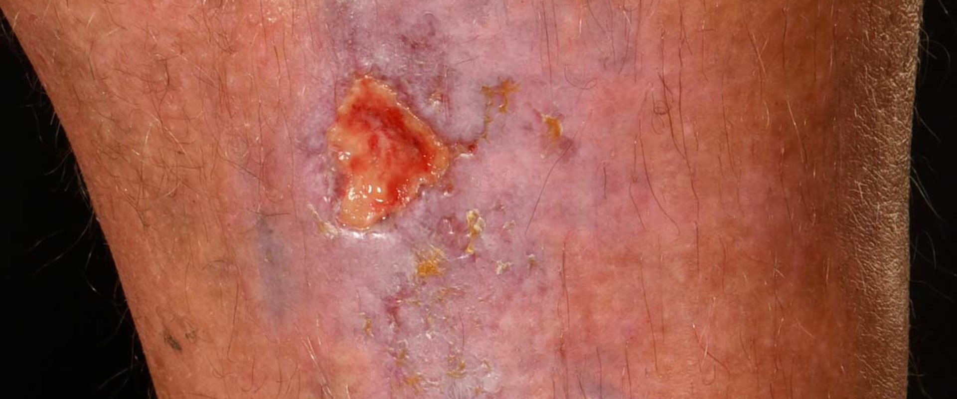 Understanding Skin Ulcers: What You Need to Know