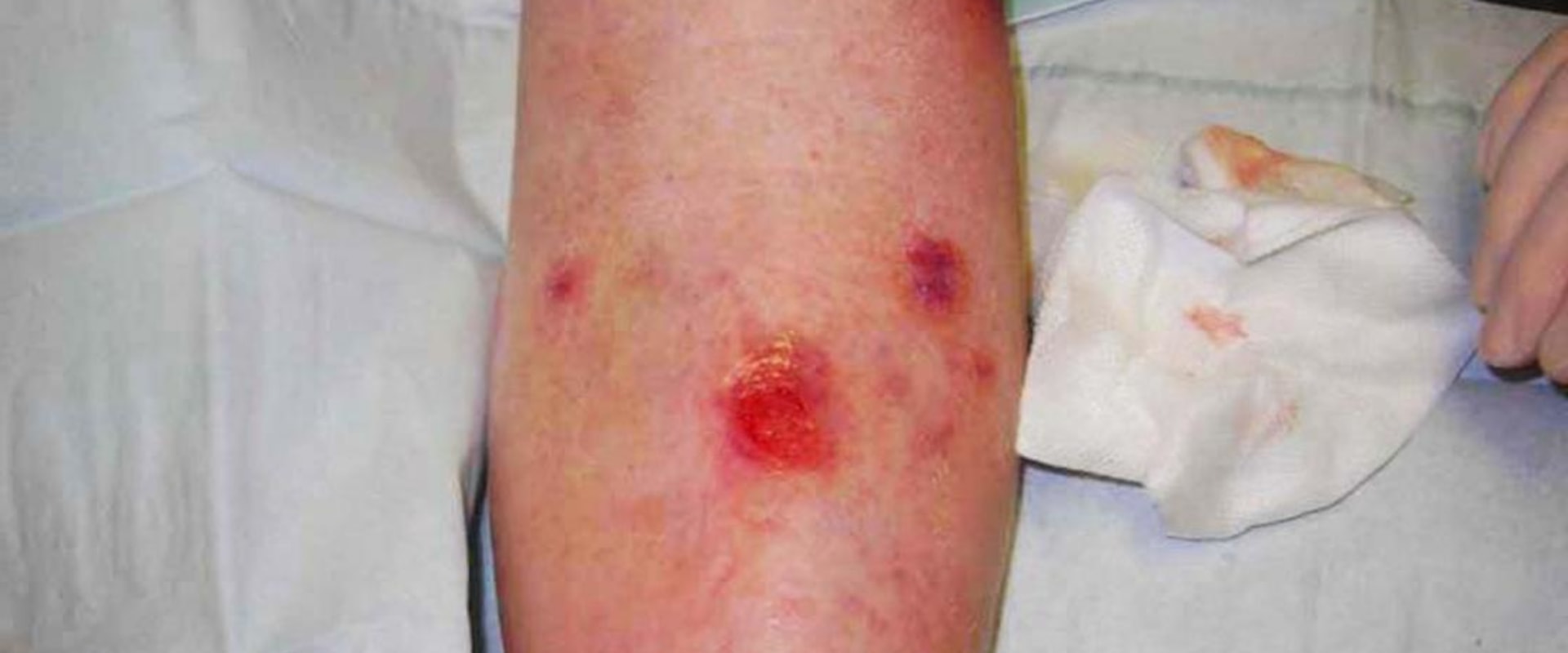 The Journey of Healing Skin Ulcers: Insights from a Wound Care Expert