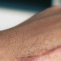 Hypertrophic Scar Healing Stages and Their Role in Skin Ulcer Treatment