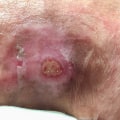 Expert Tips for Treating and Preventing Skin Ulcers