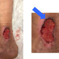 The Importance of Properly Treating and Covering Wounds