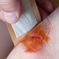 The Best Antibiotic Cream for Wound Healing