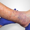 The Power of Moisture: Accelerating Wound Healing for Ulcers