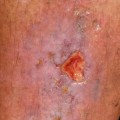 Understanding Skin Ulcers: What You Need to Know