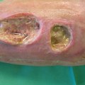 The Journey of Healing Skin Ulcers: Insights from a Wound Care Expert