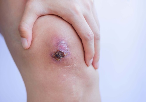 Understanding the Most Common Type of Skin Ulcer