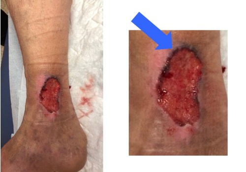 The Importance of Properly Treating and Covering Wounds