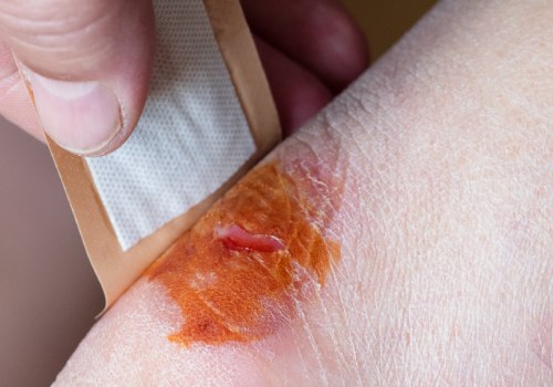 The Best Antibiotic Cream for Wound Healing