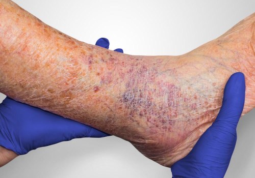 The Power of Moisture: Accelerating Wound Healing for Ulcers