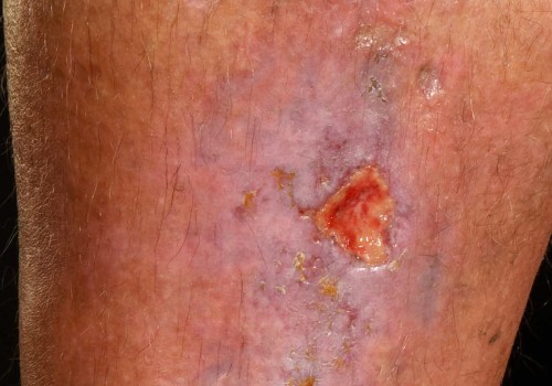 Understanding Skin Ulcers: What You Need to Know