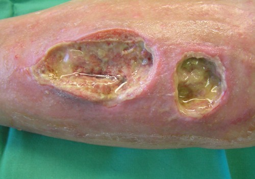 The Journey of Healing Skin Ulcers: Insights from a Wound Care Expert