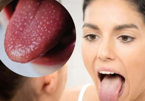 The Surprising Connection Between Mouth Ulcers and Vitamin B12 Deficiency